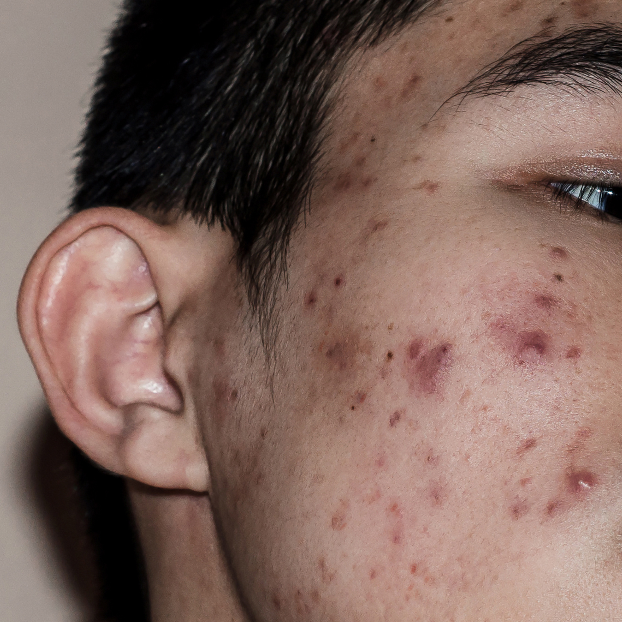 Acne