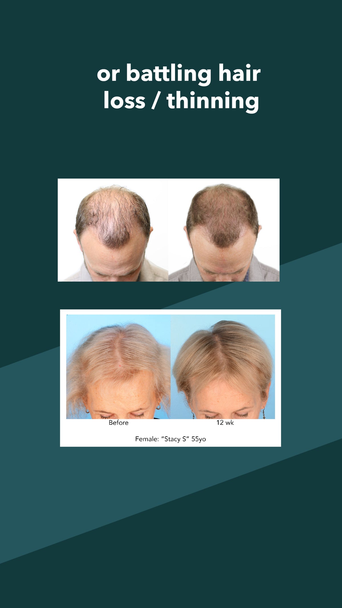 AnteAGE Microchanneling Hair Solution