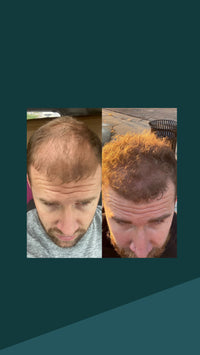 AnteAGE Microchanneling Hair Solution